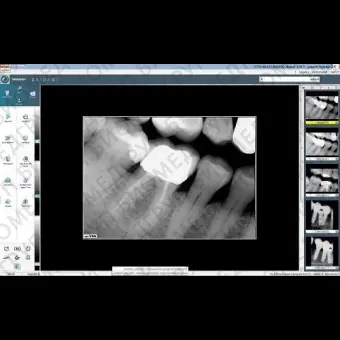 Программное обеспечение для обработки снимков зубов Visiodent