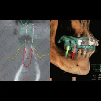 Программное обеспечение для стоматологической имплантологии R2GATE