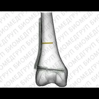Компрессионная костная пластина для мыщелка бедренной кости DCS