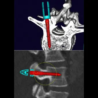 Программное обеспечение для МРТ mediCAD 3D Spine