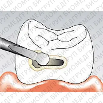 Sonicflex bevel 58  насадка для минимально инвазивной терапии кариеса с алмазным покрытием, мезиальная