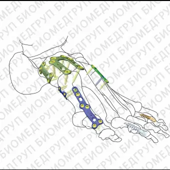 Костная пластина для артродеза ступня HJFoot VALOC 04