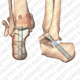 Интрамедуллярный штифт для пяточной кости CALCANAIL