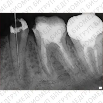 PORTX II  портативный высокочастотный интраоральный рентгеновский аппарат