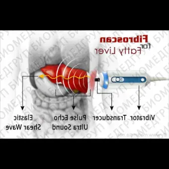 Программное обеспечение CAP Controlled Attenuation Parameter