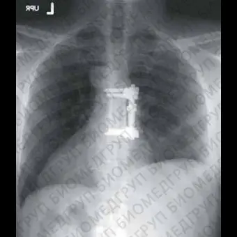 Пластина скоба XIA anterior, с двумя отверстиями, каудальная, средняя