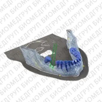 Программное обеспечение для стоматологической имплантологии Reconstruction 3D