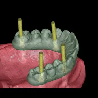 Программное обеспечение для стоматологической имплантологии Occlusally Screwed Bridges