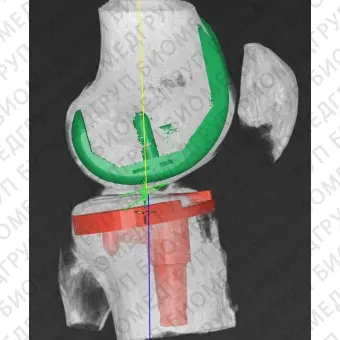 Медицинское программное обеспечение mediCAD 3D Knee
