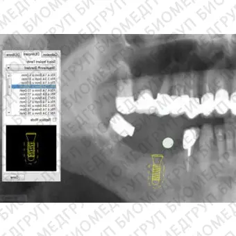 Программное обеспечение для обработки снимков зубов DEXIS