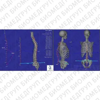 Система оценки осанки 3D B.A.K. Body Analysis Kapture