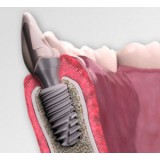 Конический зубной имплантат In-Kone® UNIVERSAL