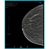 Модуль программного обеспечения для маммографии Med Mammo Tomo